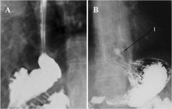Рентгенограмма больного с грыжей пищеводного отверстия диафрагмы. 1 - стрелкой указана часть желудка проникшая в грудную клетку. 