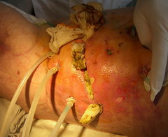 Хирургического лечения острого деструктивного панкреатита thumbnail