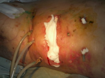Острый панкреатит деструктивный хирургическое лечение thumbnail